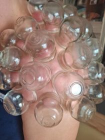 Terapie bańkami ogniowymi i bezogniowymi.