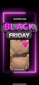 Biopeeling! Black friday!